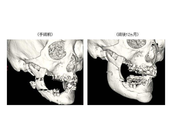 東大ら 3dプリンタで成形する人工骨の薬事承認申請を完了 Optronics Online オプトロニクスオンライン