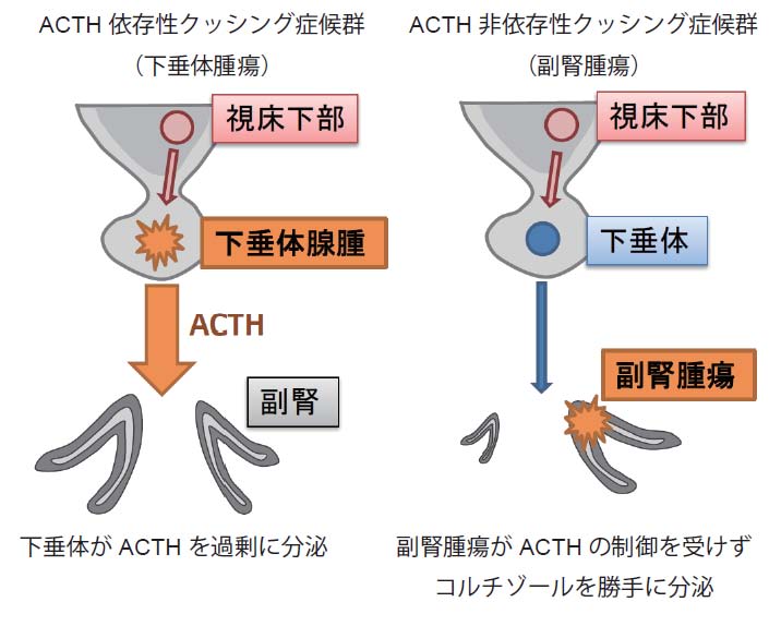 クッシング症候群には高カリウム血症または低血糖症がありますか?