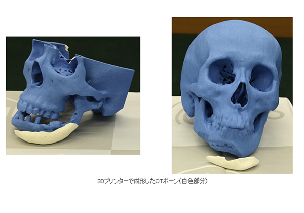 NEDOの3Dプリンタによる人工骨，欧州で販売