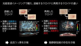 京大、光超音波イメージングを用いてケロイドの再発兆候を三次元可視化
